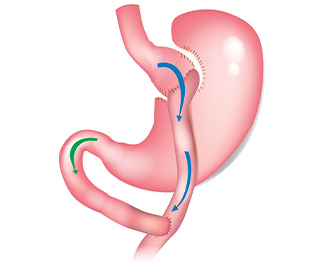 Roux-En-Y Gastric Bypass