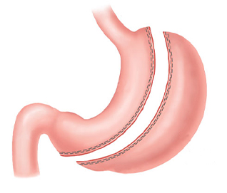 Sleeve Gastrectomy